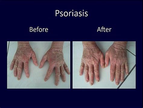 Psoriasis before and after photos | Psoriasis, Giving, Pandora screenshot