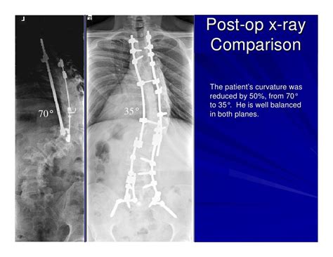 Case Review #1: 42 year old make with Adult Scoliosis Harrington Rod ...