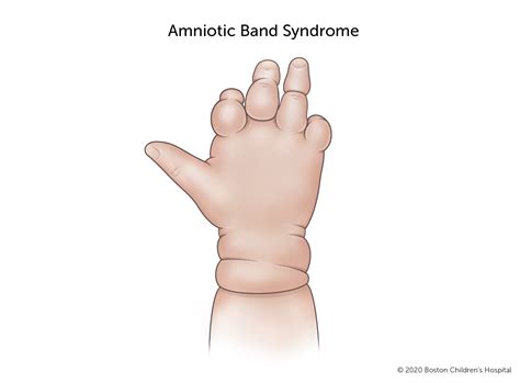 Amniotic Band Syndrome | Boston Children's Hospital