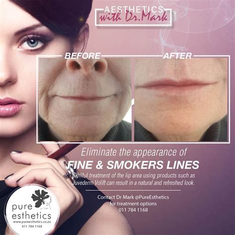 Best 25+ Smokers lines ideas on Pinterest | Lip fillers before after, Juvederm before and after ...