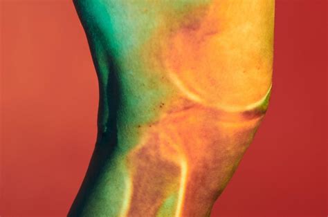 An ACL Tear That Heals Itself? – OrthoFeed