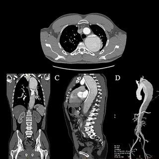 April 2020 CT aortogram demonstrating a large 72.7 mm × 68.6 mm ...