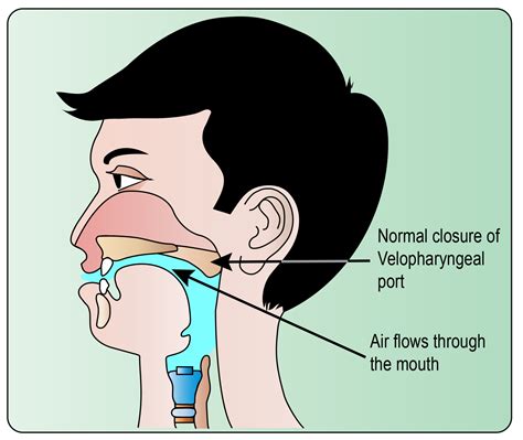 Pharyngoplasty Surgery in India | Pharyngoplasty in India