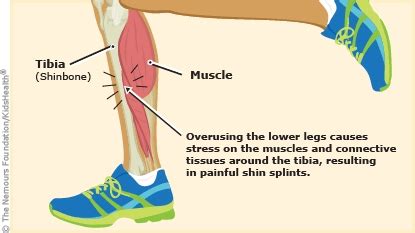 Shin Splints (for Parents) - Dayton Children's