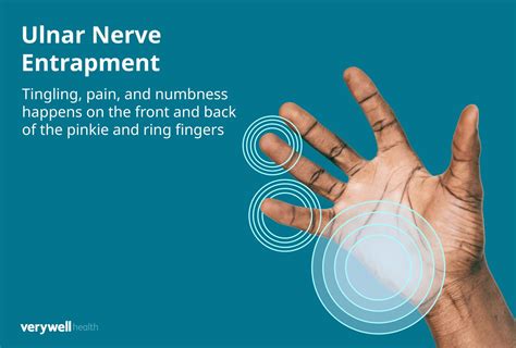 Ulnar Nerve Entrapment: Symptoms, Causes, Treatment