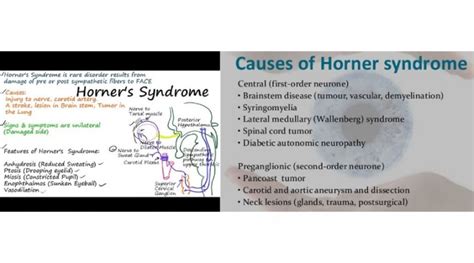 An Overview of Horner Syndrome | OBN