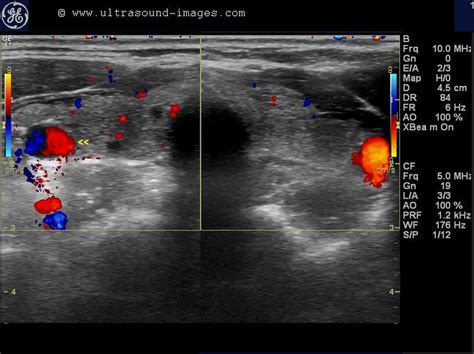 Labeled Thyroid Ultrasound