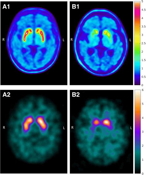 Dopamine transporter imaging with [18F]FE-PE2I PET and [123I]FP-CIT SPECT—a clinical comparison ...