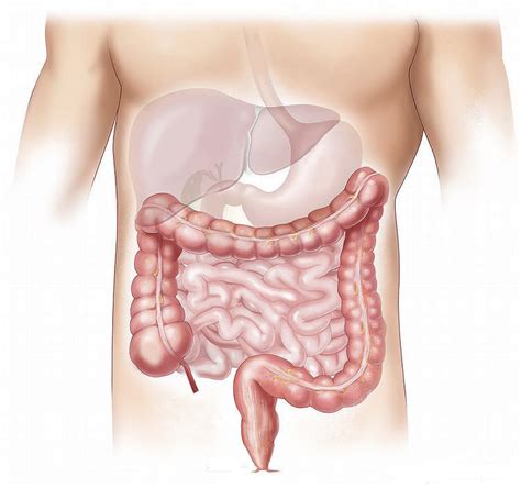 Short bowel syndrome – Patient Worthy