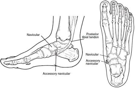 Accessory Navicular Bone Pain: Causes, Symptoms & Treatment