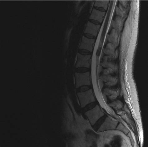 Sagital T1-weighted MRI of the lumbar spine disclosed a 2 x 1 cm... | Download Scientific Diagram