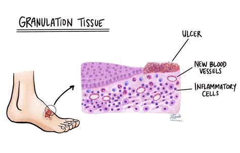 Грануляционная ткань | MyPathologyReport.ca