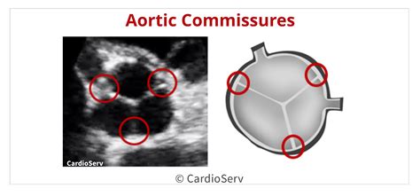 Back to the Basics: Aortic Valve Anatomy Cardioserv