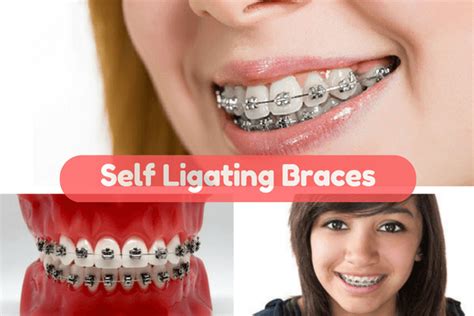 Self Ligating Braces, Pros, Cons, Cost, Brands, Ceramic type