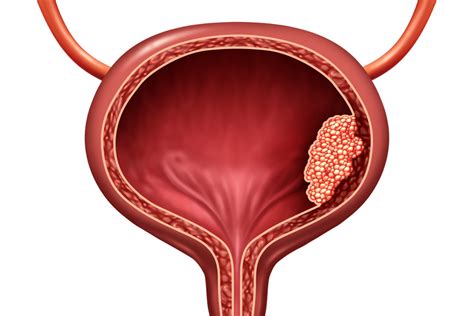 Intravesical Gene Therapy for Non-Muscle Invasive Bladder Cancer - ACE ...