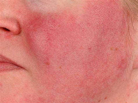 Erythrosis facialis (couperose, rode wangen)