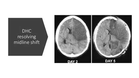 Decompressive hemicraniectomy for Large Hemispheric infarction