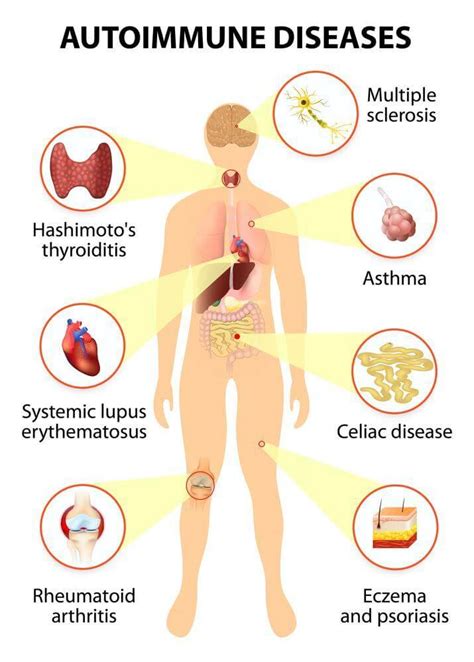 Colostrum for Autoimmune Diseases – BodyBoost Colostrum