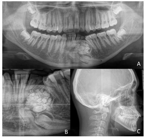 Children | Free Full-Text | Characteristics, Diagnosis and Treatment of Compound Odontoma ...