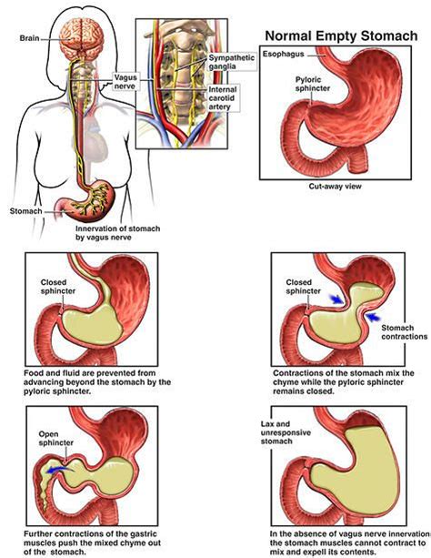 Pin on gastroparesis