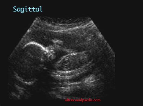 Pulmonary hypoplasia – ULTRASOUNDPAEDIA