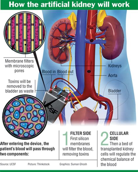 Artificial Kidney Using Nanotechnology - RENAL REPLACEMENT INNOVATION CORP.