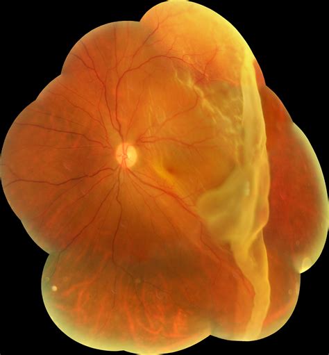 RETINAL DETACHMENT - Dr Rehman Siddiqui