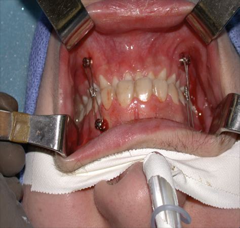 A Comparison of Anterior vs Posterior Isolated Mandible Fractures ...