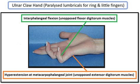 Ulnar Nerve Deformity