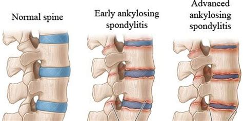 Symptoms of Ankylosing Spondylitis | by Rashika Naman | Medium