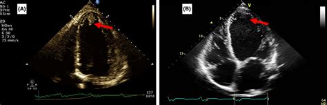 Use of direct oral anticoagulants in the treatment of left ventricular thrombi: A tertiary ...