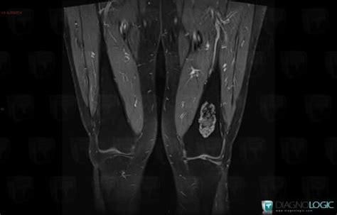 Radiology case : Enchondroma (MRI) - Diagnologic