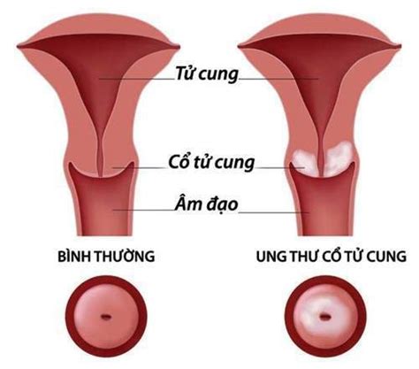 Nhận biết ung thư cổ tử cung - Bệnh Viện Thẩm Mỹ Bangkok Hospital ...