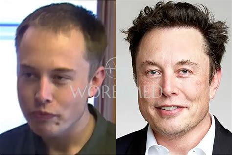 Elon Musk Hair Transplant l Before and After