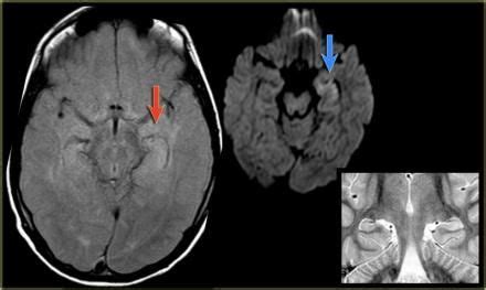 The Radiology Assistant : Brain - Epilepsy: Role of MRI (с изображениями)