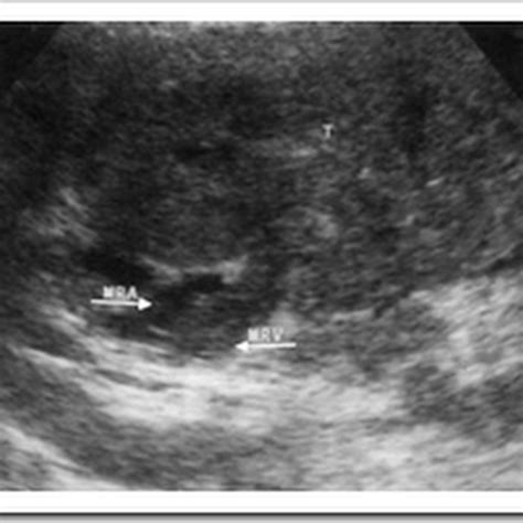 Ultrasound images of Renal cell carcinoma (RCC) - Radiology Imaging