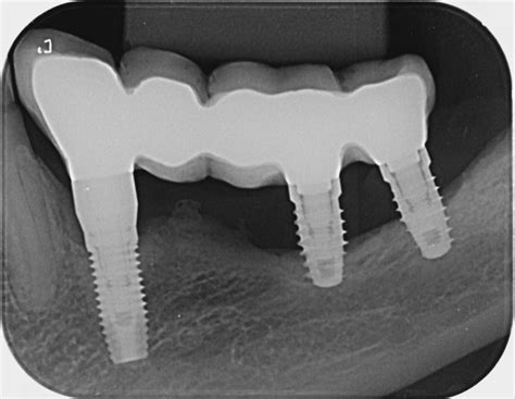 Overview: an explantation of dental implants - ITI Blog