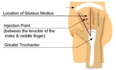 The Ventrogluteal Injection Site - HealthProAdvice