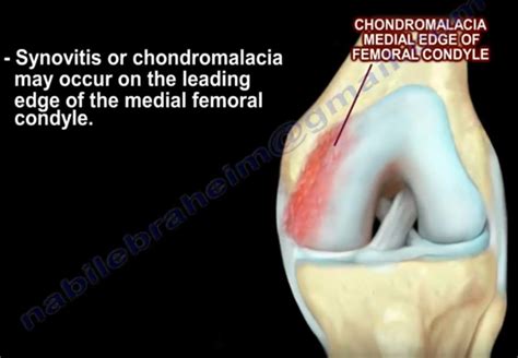 Knee Plica — OrthopaedicPrinciples.com