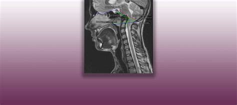 Platybasia | Institut Chiari & Syringomyelia & Scoliosis Barcelona