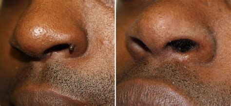 Wart Removal Nose Results Photo | London Mole Removal