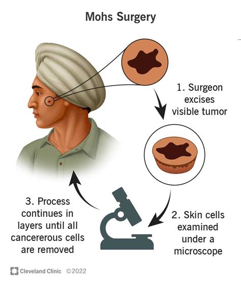 Top 19 basal cell cancer mohs surgery 2022