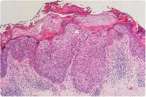 CIENCIASMEDICASNEWS: Bowen's Disease Signs and Symptoms