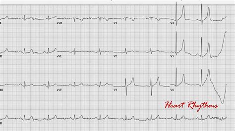 Ecg Rhythms Tented T Waves Of Hyperkalemia | Images and Photos finder