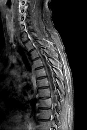 Osteoid osteoma - spine | Radiology Case | Radiopaedia.org