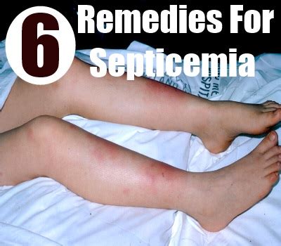 6 Amazing Home Remedies For Septicemia - Natural Treatments & Cures | Natural Home Remedies ...