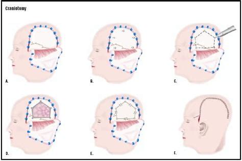 Craniotomy - procedure, recovery, blood, removal, pain, complications, adults, time