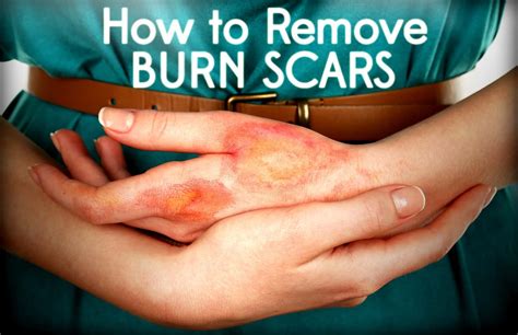 Burn Scars | Medscar