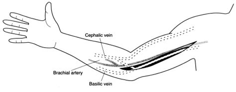 Transposition of the basilic vein for arteriovenous fistula: an endoscopic approach1 - Journal ...