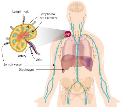 How is Follicular Lymphoma Diagnosed? - ZEVALIN.com - Patient Site